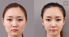 都說顴骨整形術(shù)很危險，它的危險性真的很高嗎？