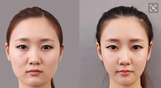 都說顴骨整形術(shù)很危險(xiǎn)，它的危險(xiǎn)性真的很高嗎？