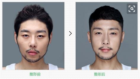 顴骨整形手術(shù)原理