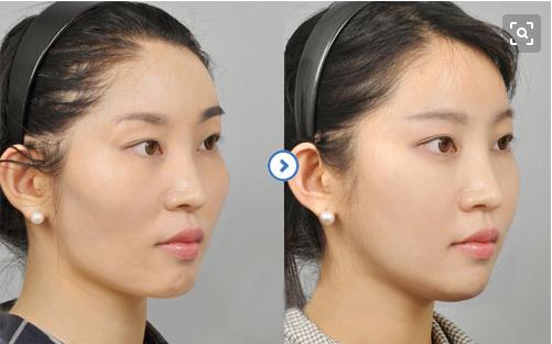 磨顴骨風(fēng)險(xiǎn)大嗎?