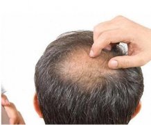 植發(fā)的價錢大概多少？按什么收費的？