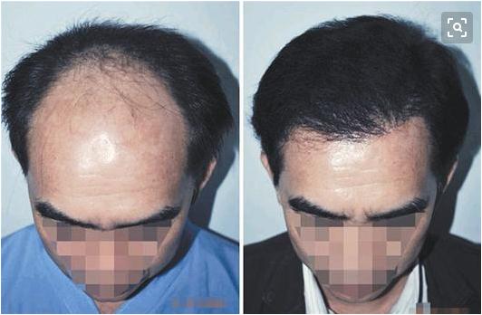 毛發(fā)移植后要多久才能看到果？