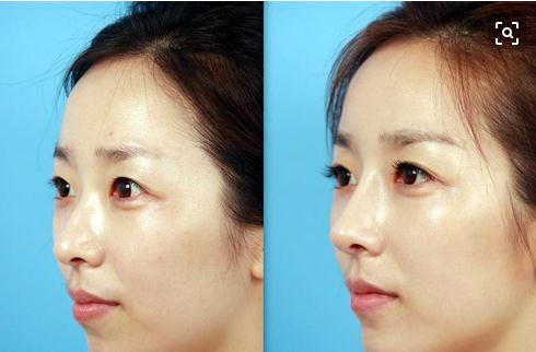 硅膠隆鼻能放一輩子嗎?硅膠的使用期限是多久?