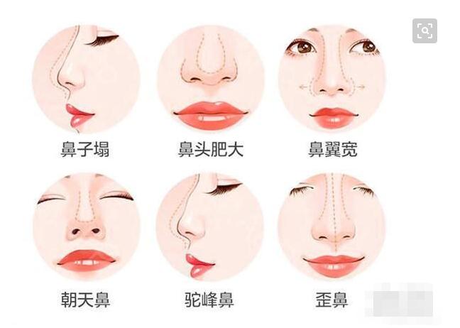 硅膠隆鼻果好嗎？