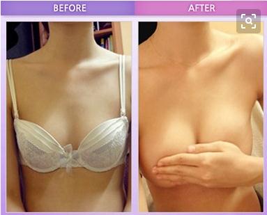 假體隆胸手術多久才能完全恢復？