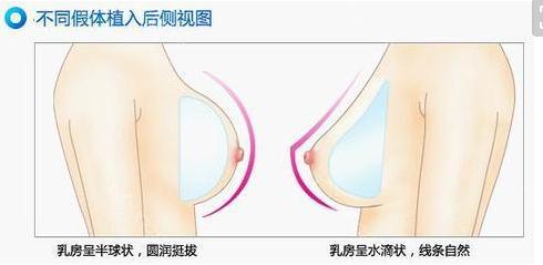 假體隆胸手術多久才能完全恢復？
