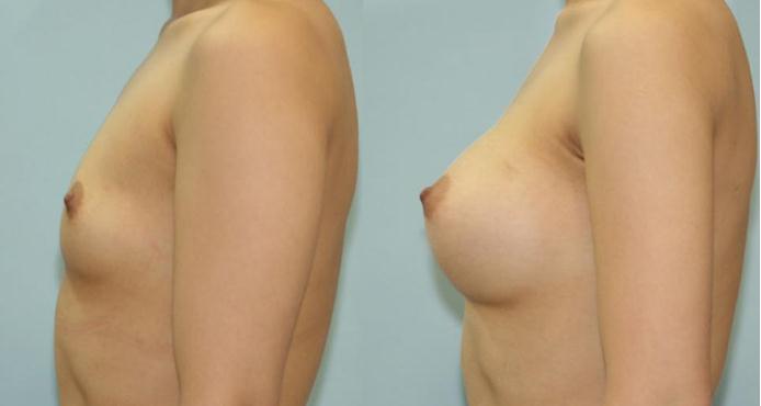 假體隆胸手術多久才能完全恢復？