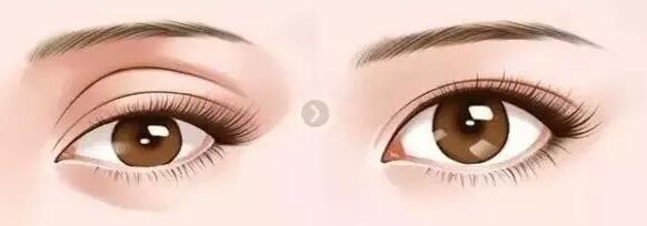 上海華美葉麗萍做雙眼皮怎么樣 簡(jiǎn)介