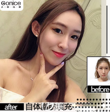 西安高一生自體脂肪填充面部案例