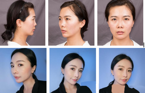 上海華美鼻部手術(shù)怎么樣？