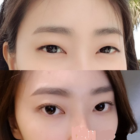 韓國(guó)的純真整形手術(shù)對(duì)整形手術(shù)有好處嗎？