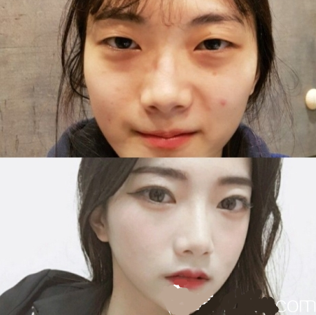 韓國(guó)的純真整形手術(shù)對(duì)整形手術(shù)有好處嗎