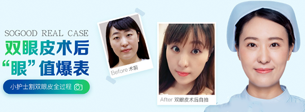 王娟切開(kāi)雙眼皮案例果圖：廣州曙光王娟雙眼皮案例