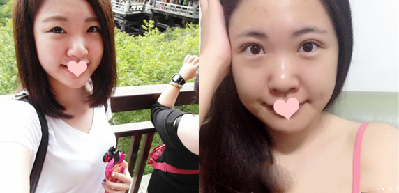 王娟醫(yī)生做的切開(kāi)雙眼皮案例