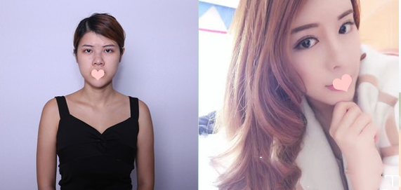 劉永波醫(yī)生做的隆鼻失敗修復(fù)案例