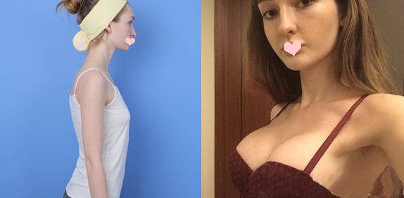 孫婧醫(yī)生做的假體隆胸案例