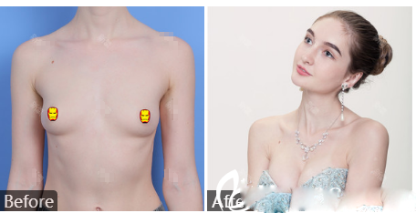 蔣思軍耳軟骨復(fù)合隆鼻和膨體隆鼻案例：廣州曙光蔣思軍耳軟骨復(fù)合隆鼻和膨體隆鼻案例