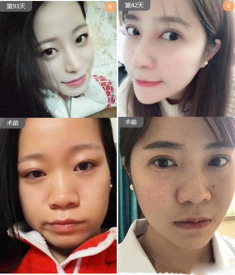 蔣思軍耳軟骨復(fù)合隆鼻和膨體隆鼻案例：廣州曙光蔣思軍耳軟骨復(fù)合隆鼻和膨體隆鼻案例