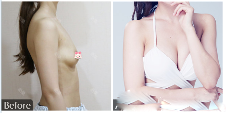 劉杰偉260cc曼托假體隆胸隆胸案例