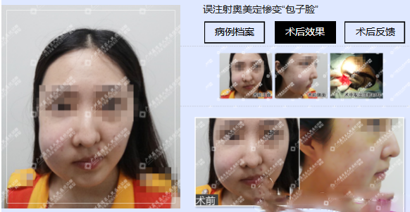 廣州市荔灣區(qū)人民醫(yī)院整形外科奧美拉唑清除案例研究