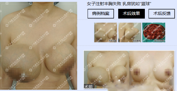 廣州市荔灣區(qū)人民醫(yī)院整形外科胸奧美拉唑調(diào)節(jié)病例