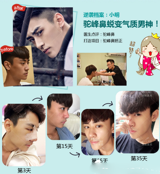 深圳美萊隆鼻一個月恢復(fù)過程圖