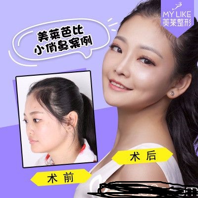 深圳美萊醫(yī)療整形美容醫(yī)院鼻部手術(shù)隆鼻案例