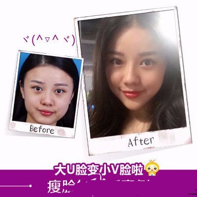 深圳美萊醫(yī)療整形美容醫(yī)院注射瘦臉案例