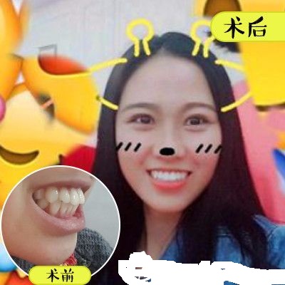 深圳美萊口腔醫(yī)院金屬托槽牙齒矯正案例