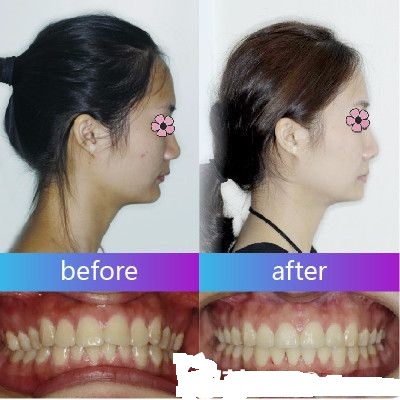 深圳美萊口腔醫(yī)院美式金屬牙齒矯正正牙案例