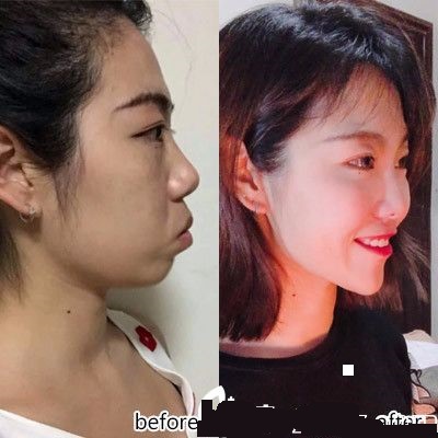 深圳美萊口腔醫(yī)院陶瓷隱形牙齒矯正案例