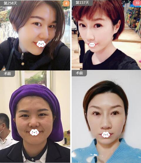 南寧華美劉真俊做的隆鼻案例對比圖