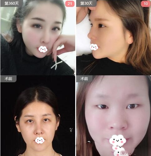 南寧華美張成春做的雙眼皮案例