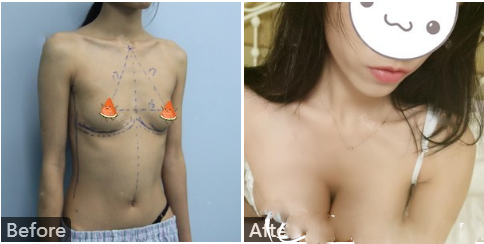 南寧華美趙麗紅做的假體隆胸術(shù)后一個月對比