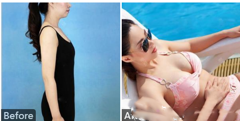 南寧華美趙麗紅假體隆胸案例術(shù)后一年果對比
