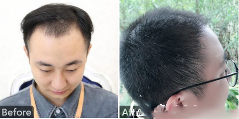 南寧華美胡黎萍做的發(fā)際線種植案例