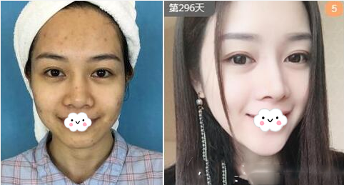 南寧華美張穎點陣激光案例