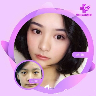 佛山華美整形美容醫(yī)院雙眼皮切口