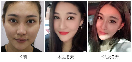 佛山華美學(xué)院梁宗建院長自體脂肪塑料面部填充的案例研究