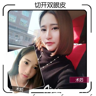 佛山華美梁宗堅雙眼皮切開案