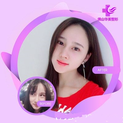 佛山華美醫(yī)療整形美容醫(yī)院薄面針案例分析