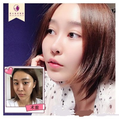 王高鳳做的雙眼皮隆鼻手術(shù)