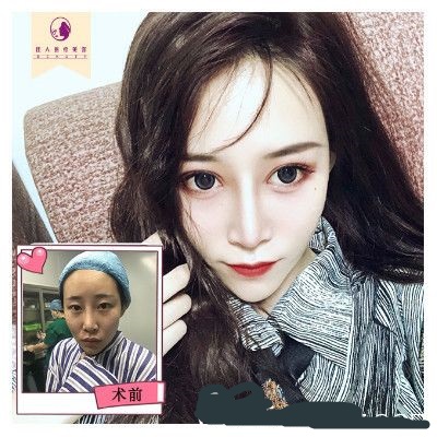 由王高峰完成的眼部合成+鼻部合成隆鼻+自體脂肪面部填充的案例