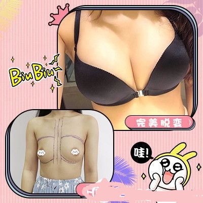 高風(fēng)假體隆胸案例