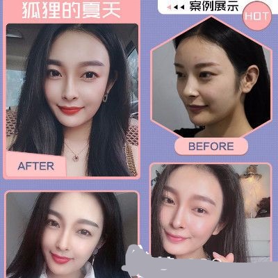 曹平進(jìn)行面部線條雕刻和埋線促銷的示例