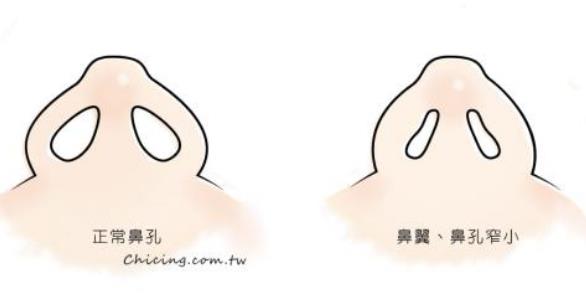 鼻翼縮小手術(shù)需要注意的事情