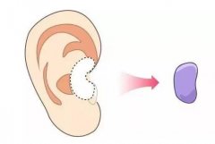 在做了耳軟骨墊鼻梁以后，耳軟骨是否會(huì)被吸收？