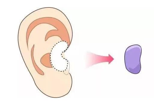 在做了耳軟骨墊鼻梁以后，耳軟骨是否會(huì)被吸收？
