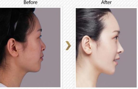 自體耳軟骨隆鼻的優(yōu)勢