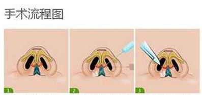 蒜頭鼻矯正手術(shù)